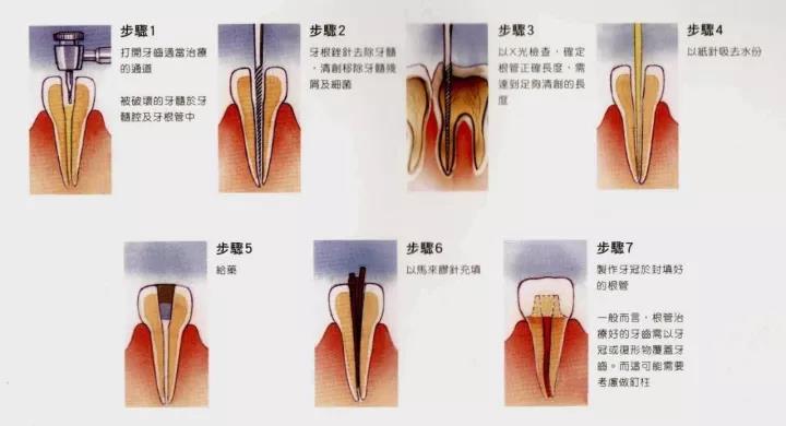 所以根管治疗是在不得已时舍弃牙髓而保留牙齿继续行使功能的一种
