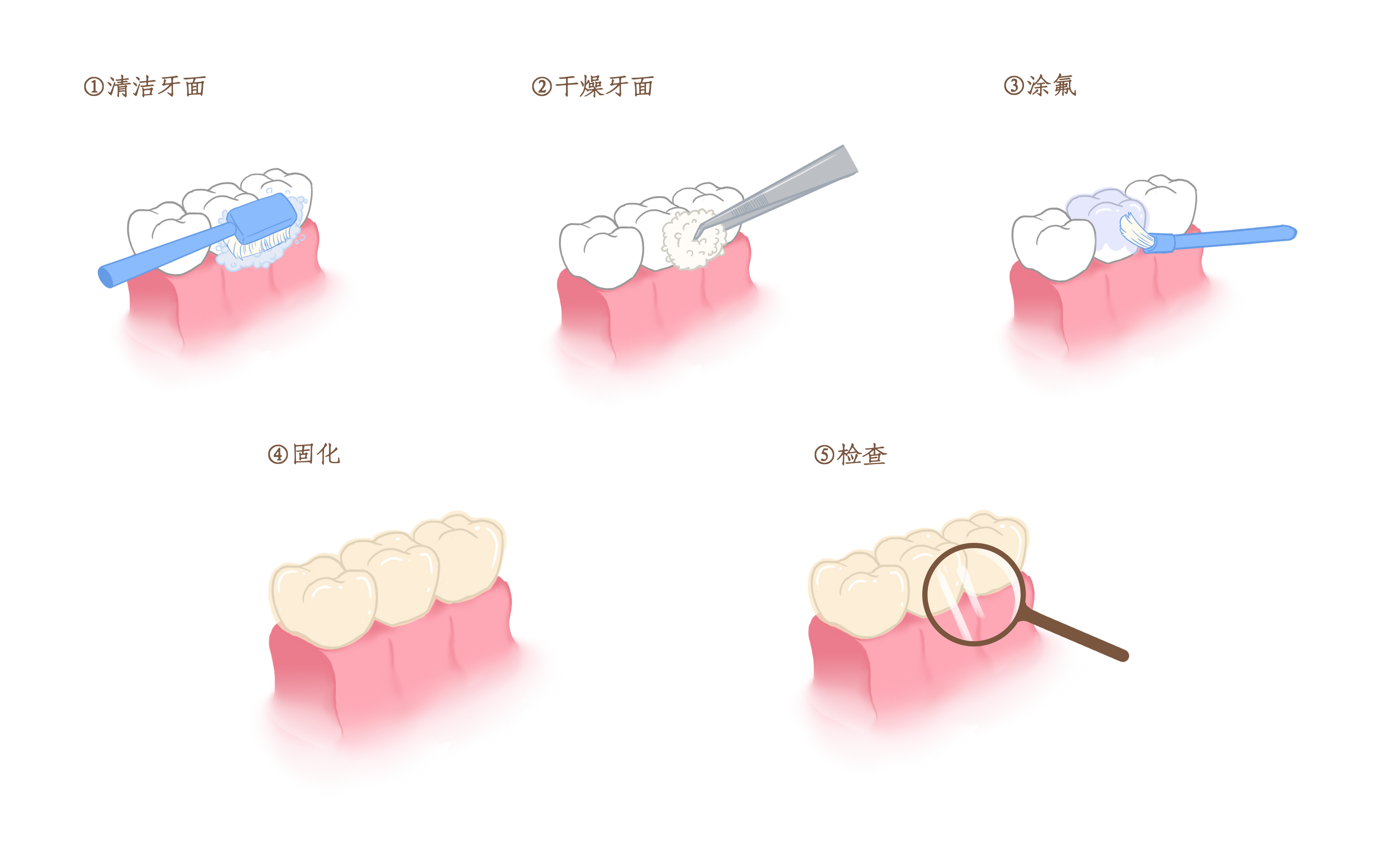 摄图网_401800107_牙齿涂氟步骤科普插画（非企业商用）.jpg