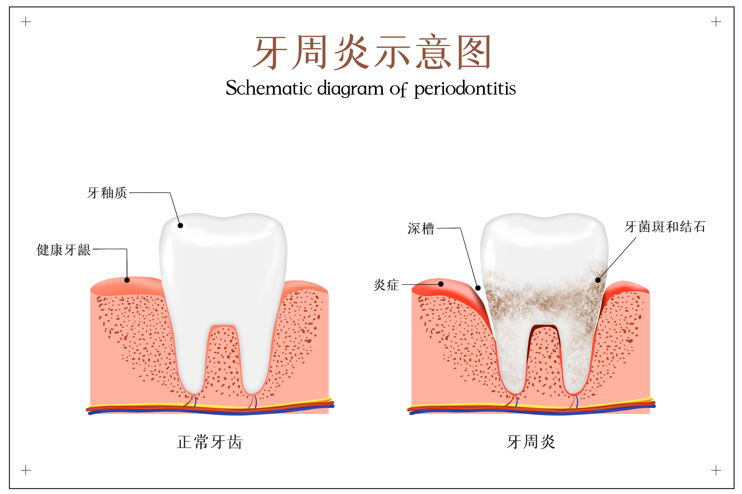 摄图网_401803633_牙周炎示意图（非企业商用）.jpg